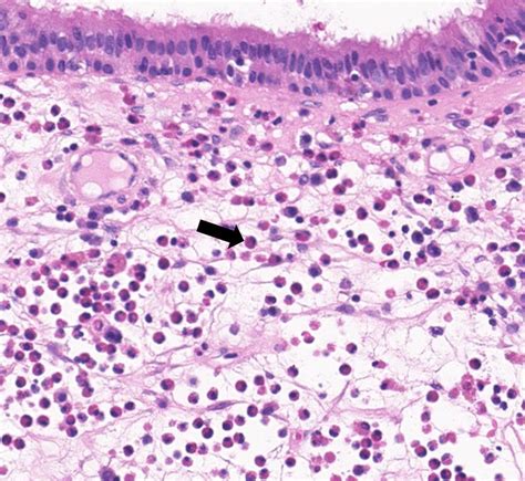 Typical Histopathologic Manifestations Of Tissue Eosinophilia