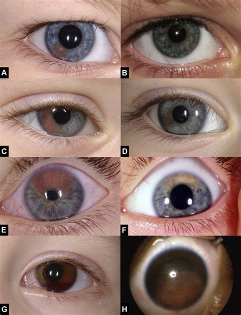 Juvenile Xanthogranuloma Involving The Eye And Ocular Adnexa