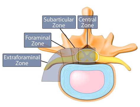 The Difference Between Bulging Disc And Herniated Disc 2022