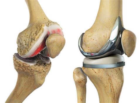 Nov 26, 2018 · understanding swelling and scar tissue after knee replacement the composition of the swelling that occurs in the knee depends on how long it's been there. Total Knee Replacement Recovery: What To Expect - Knee ...