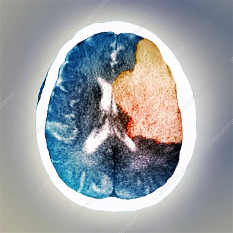 Brain In Stroke Ct Scan Stock Image C0299807 Science Photo Library
