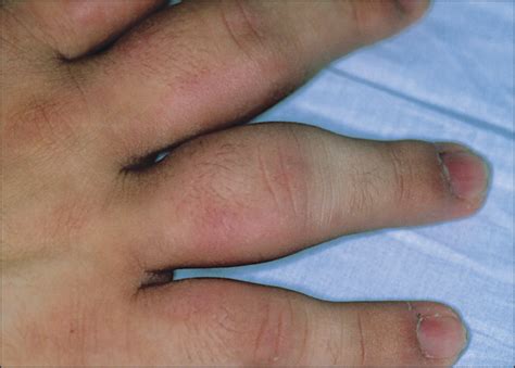 acquired fusiform swelling of the fingers—quiz case critical care medicine jama dermatology