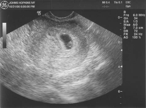 4 Week Ultrasound Pictures Search Results Calendar 2015