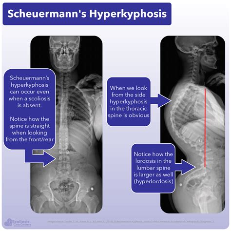 Scheuermanns Kyphosis Treatments By Our Expert Physicians