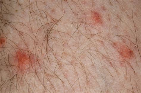 Insect Bites And Stings Symptoms Nhs