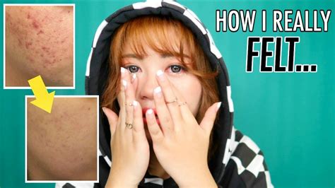 How I Got Rid Of My Acne How It Honestly Affected Me Youtube