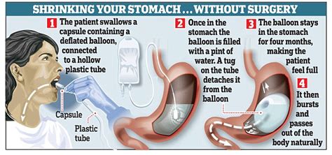 Balloon Swallowed With A Glass Of Water Lose Weight Daily Mail Online
