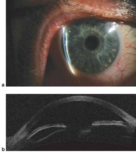 Iris Cyst As Oct American Academy Of Ophthalmology