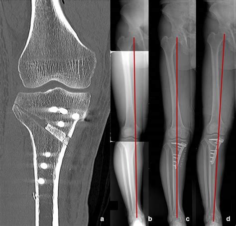 Figure From Uniplane Medial Opening Wedge High Tibial Osteotomy My