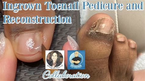 Pedicure With Toenail Reconstruction After Ingrown Toenail Removal With