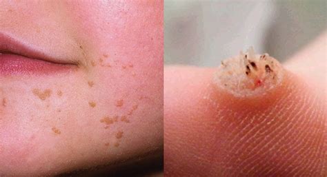 Warts are typically small, rough, hard growths that are similar in color to the rest of the skin. Cheapest Way To Effectively Remove Warts Everyone Needs To ...