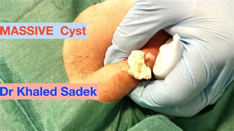 MASSIVE CYST CONTENT Dr Khaled Sadek Lipomacyst Com YouTube