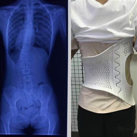 China 3d Printed Scoliosis Back Brace Manufacturers Suppliers Factory