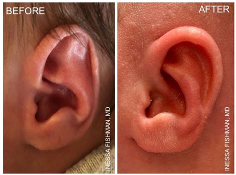Newborn Ear Correction With Earwell Newborn Girl Plastic Surgery