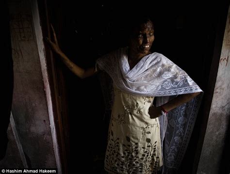 The Courageous Indian Women Scarred For Life From Acid Attacks Daily Mail Online