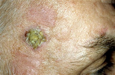 Skin Cancer On Face Pictures 33 Photos Images Illnessee