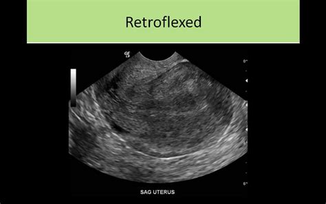 Retroflexed Uterus Ultrasound Medical Ultrasound Sonography