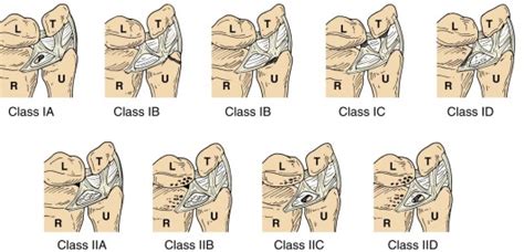 Triangular Fibrocartilage Complex Injuries Musculoskeletal Key
