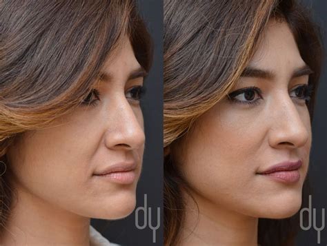 Before And After Nasolabial Fold Smile Lines With Juvederm Ultra