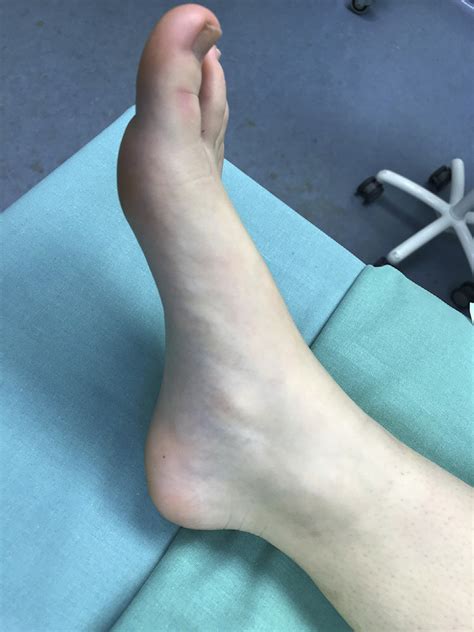 A Typical Finding In A Symptomatic Accessory Navicular Is A Painful Download Scientific Diagram