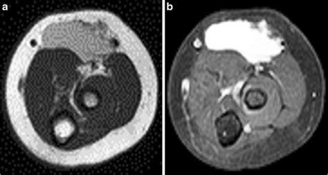 Macrocystic Lymphatic Malformation Mr Imaging In A 20 Month Old Boy A
