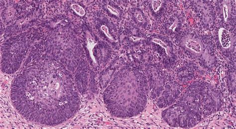 High Grade Squamous Intraepithelial Lesion Archives Atlas Of Pathology