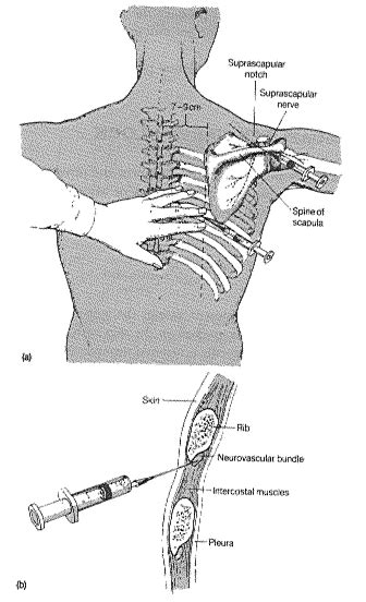 Intercostobrachial Neuralgia Armpit Nerve Pain Treatment Condition