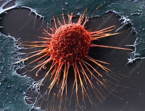 Maybe you would like to learn more about one of these? Cervical cancer cell, SEM - Stock Image - M850/0432 ...