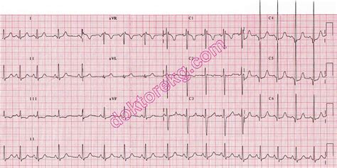 Normal Pediatric Ecg Samples Dr Mahmut Gokdemir