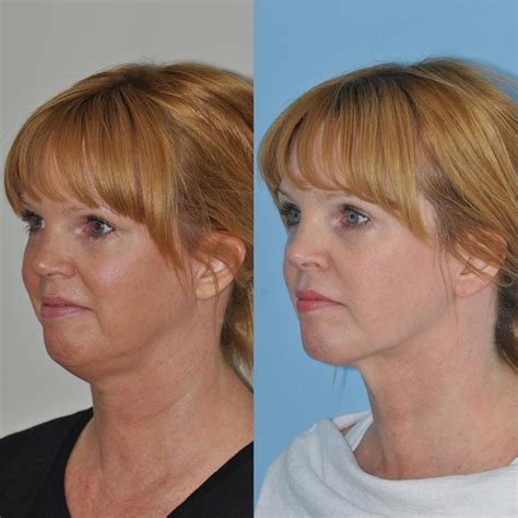 Patient 31709215 Facetite And Thermitight Before And After Photos Bloom