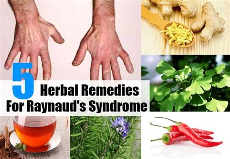 Top 5 Herbal Remedies For Raynauds Syndrome Herbal Remedies Herbalism Raynauds