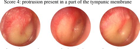 Figure From Clinical Practice Guidelines For The Diagnosis And Management Of Acute Otitis