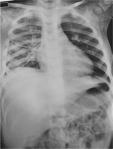 Follow Up Chest X Ray Showing Chest Tube In Place Download