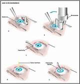 Lasik Eye Surgery Cost 2013 Images