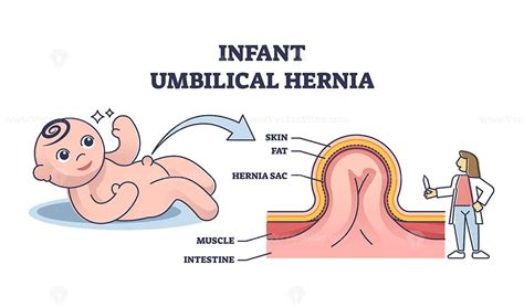 Infant Umbilical Hernia As Painless Lump Near Belly Button Outline