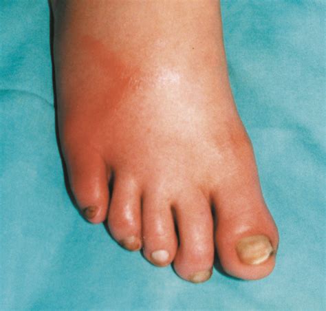 Phlebitis Foot