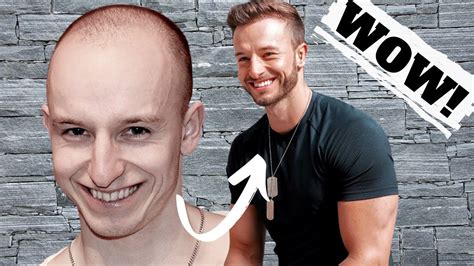 Extreme Hair Loss Transformation Expert Advice With Mattdominance