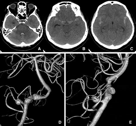 A C Ct Scans On Admission Reveal Diffuse Subarachnoid Hemorrhage With