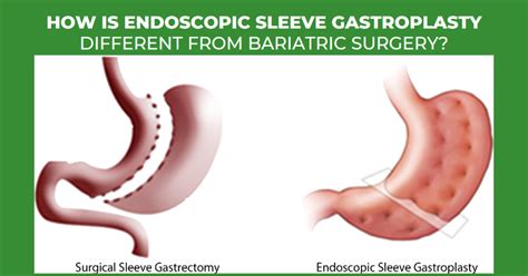 How Endoscopic Sleeve Gastroplasty Esg Different From Bariatric Surgery