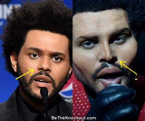 The Weeknd Plastic Surgery Comparison Photos