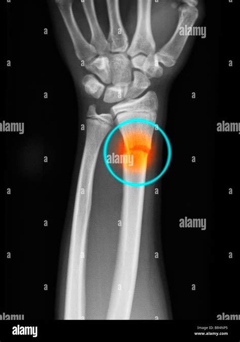 Forearm X Ray Showing A Distal Radius Fracture In A 14 Year Old Boy