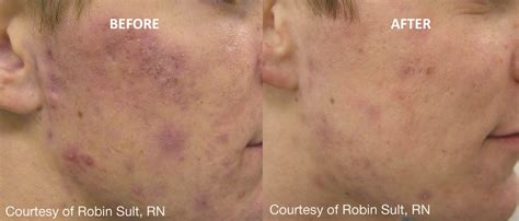 Acne Men Before And After Revive Laser And Skin Clinic