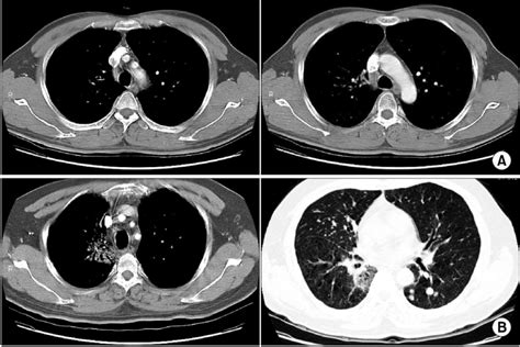 Chest Ct Findings After Thoracic Radiotherapy A Immediate