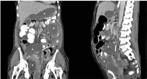 Contrast Enhanced Coronal And Sagittal Reformatted Ct Image Depicting