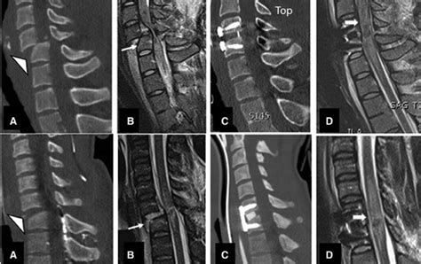 Midsagittal Ct And Mri Images Of Two Subaxial Cervical Spine Injuries