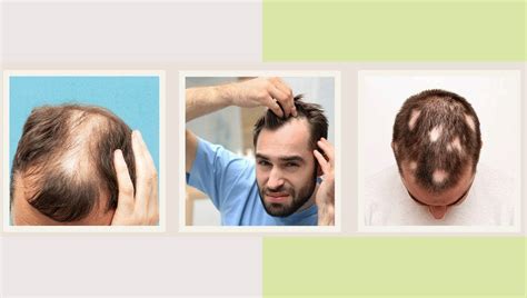 What Are The Various Abnormal Hair Loss Signs Botaniqu