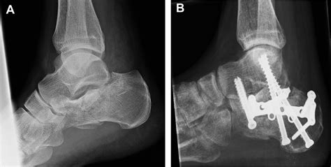 Fixation By Open Reduction And Internal Fixation Or Primary Arthrodesis