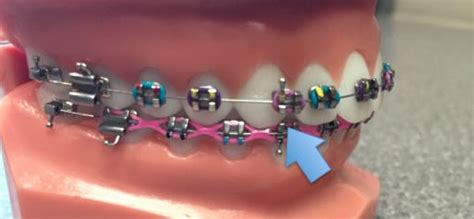 Broken Or Loose Bracket Tustin Ca Legacy Orthodontics