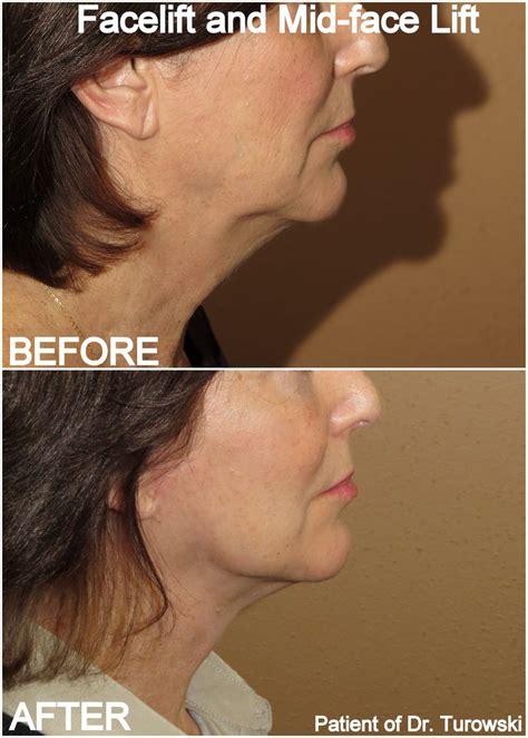 More Info And Photos Complex Facial Rejuvenation