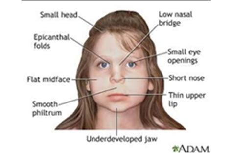 Cooleys Anemia Beta Thalassemia